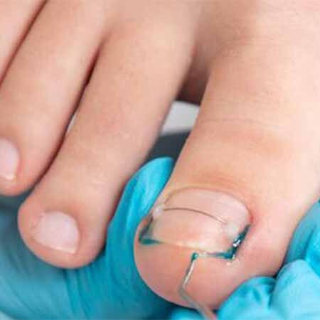 اصلاح ناخن های فرو رفته در گوشت