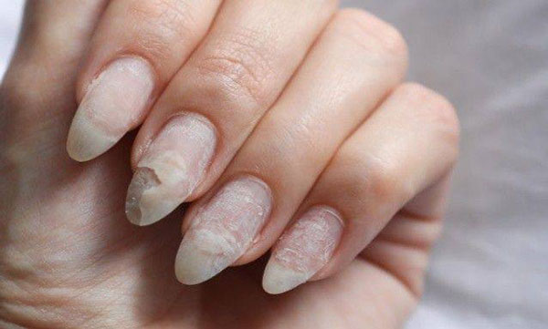 قارچ ناخن؛ علائم، دلایل و راهکارهای درمانی